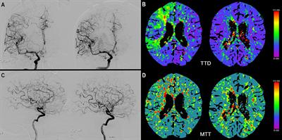 Inhaled Nitric Oxide Treatment for Aneurysmal SAH Patients With Delayed Cerebral Ischemia